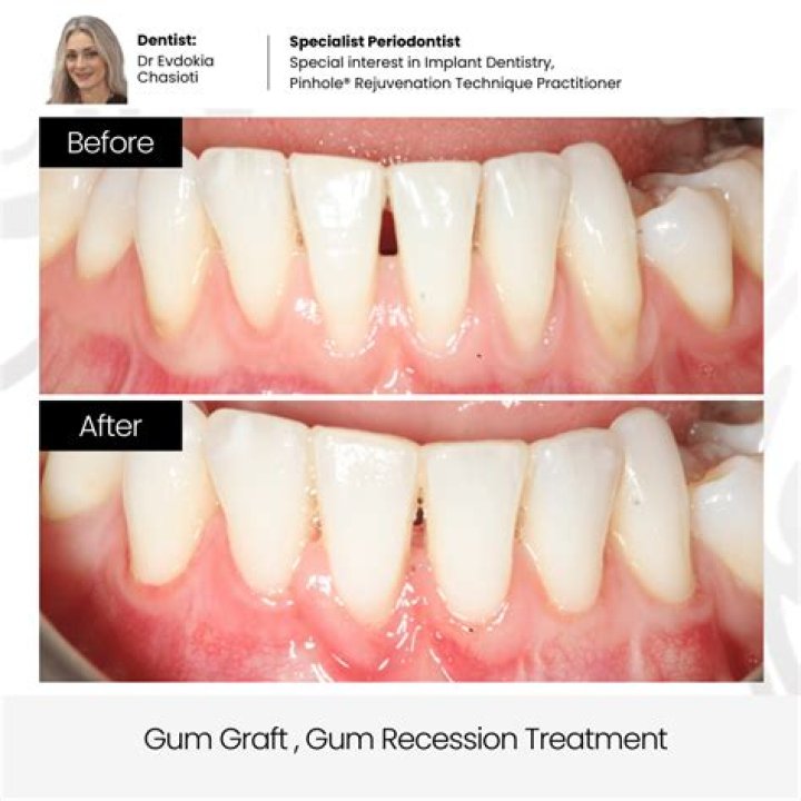Are antibiotics necessary after gum graft?