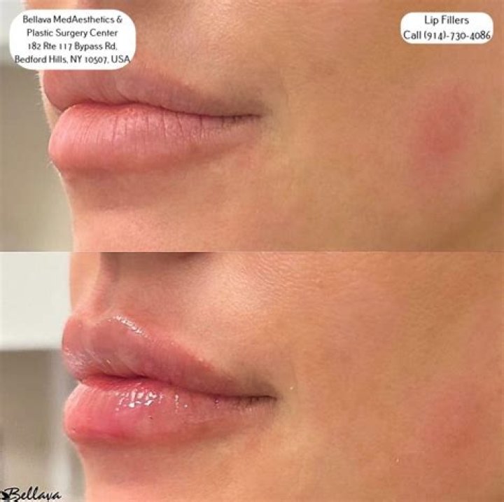 Are lip fillers still popular?