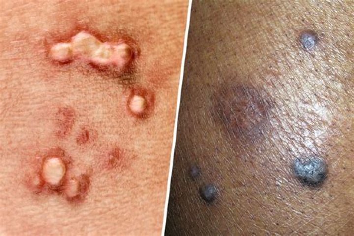 Can a woman give HPV to a man?