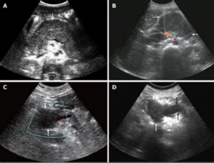 Can abdominal ultrasound see pancreas?