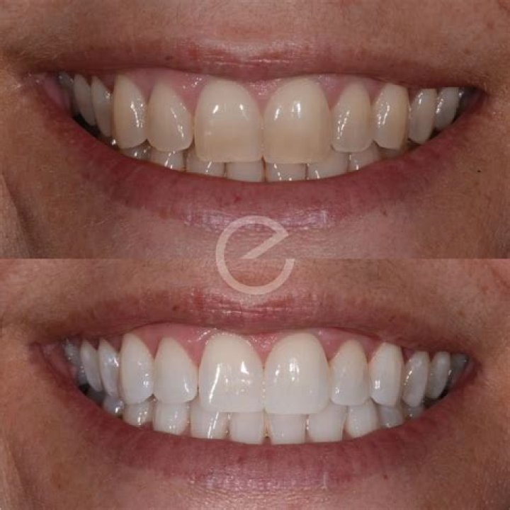 Can composite bonding be whitened?