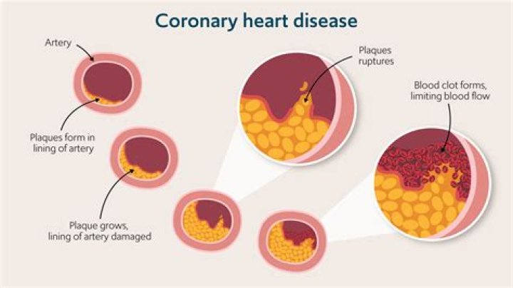 Can heart plaque reversed?