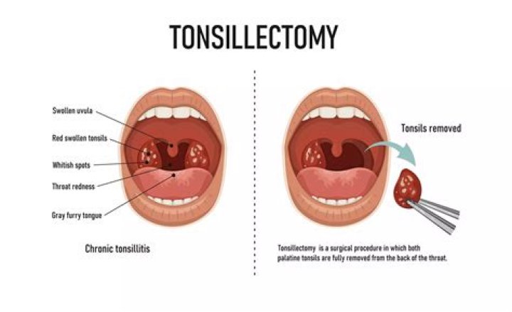 Can I hit my Juul after tonsillectomy?