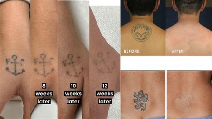 Can I take painkillers after a tattoo?
