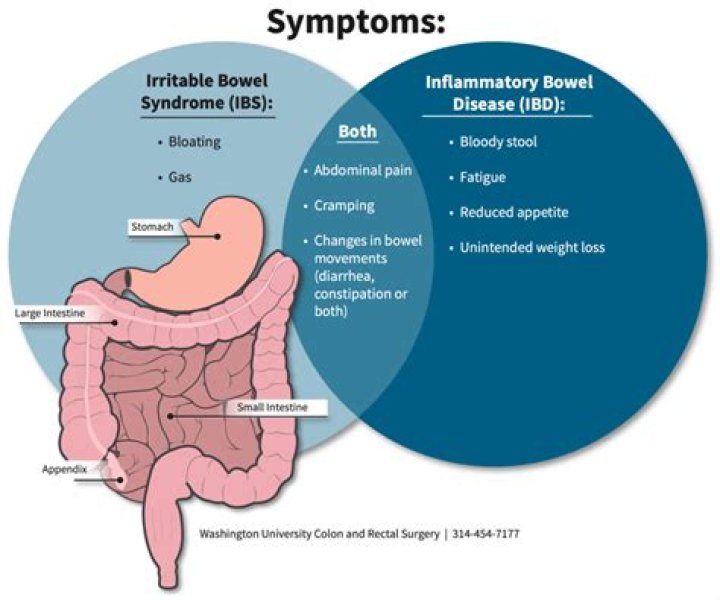 Can IBS start in your 30s?