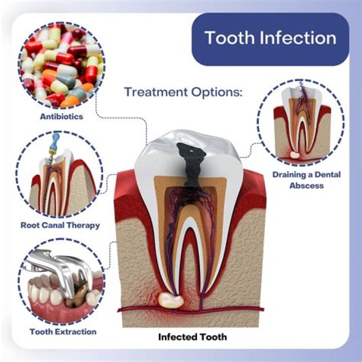 Can infection in tooth cause fatigue?