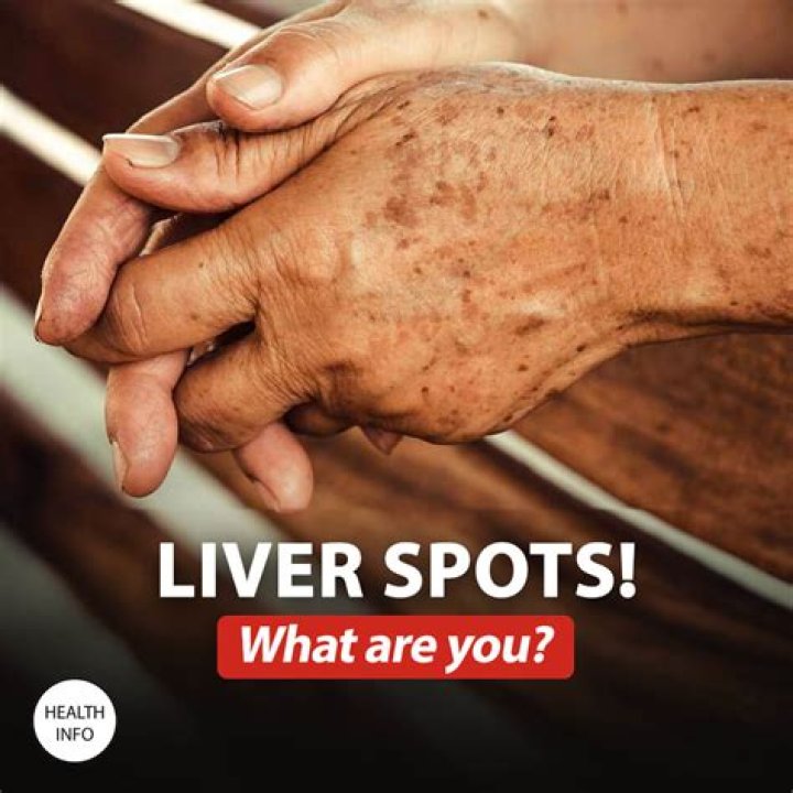 Can liver spots turn cancerous?