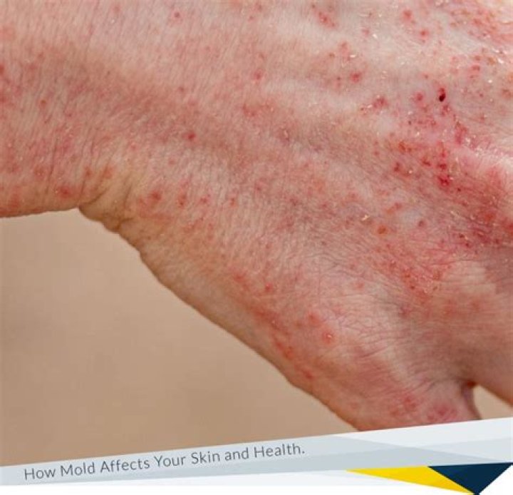 Can mold give you body aches?