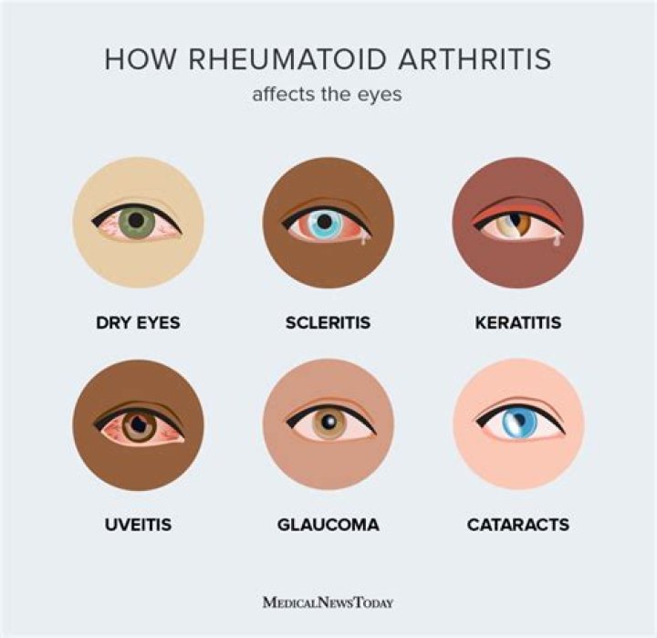Can rheumatoid arthritis affect your face?