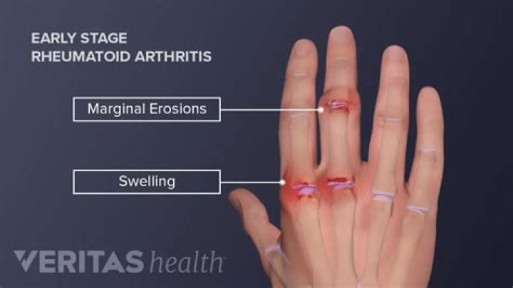Can rheumatoid arthritis be cured at early stages?