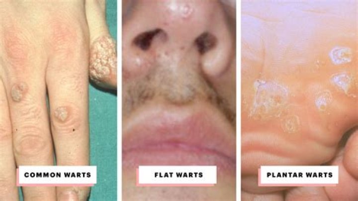 Can you dig out a wart?