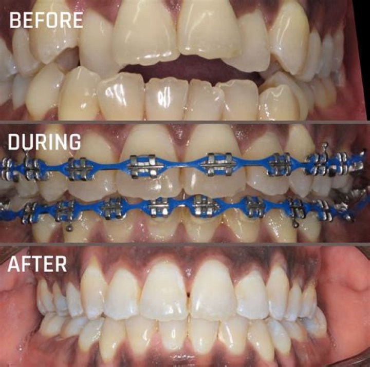 Can you have braces during surgery?