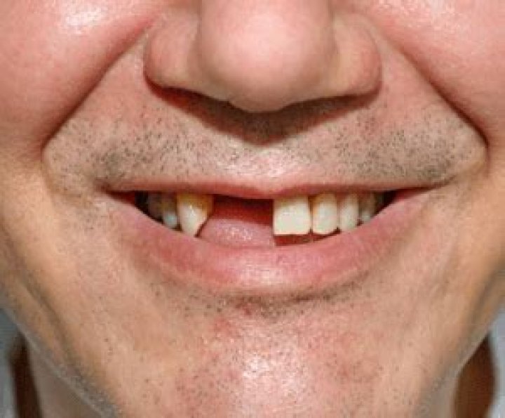 Can you survive without teeth?