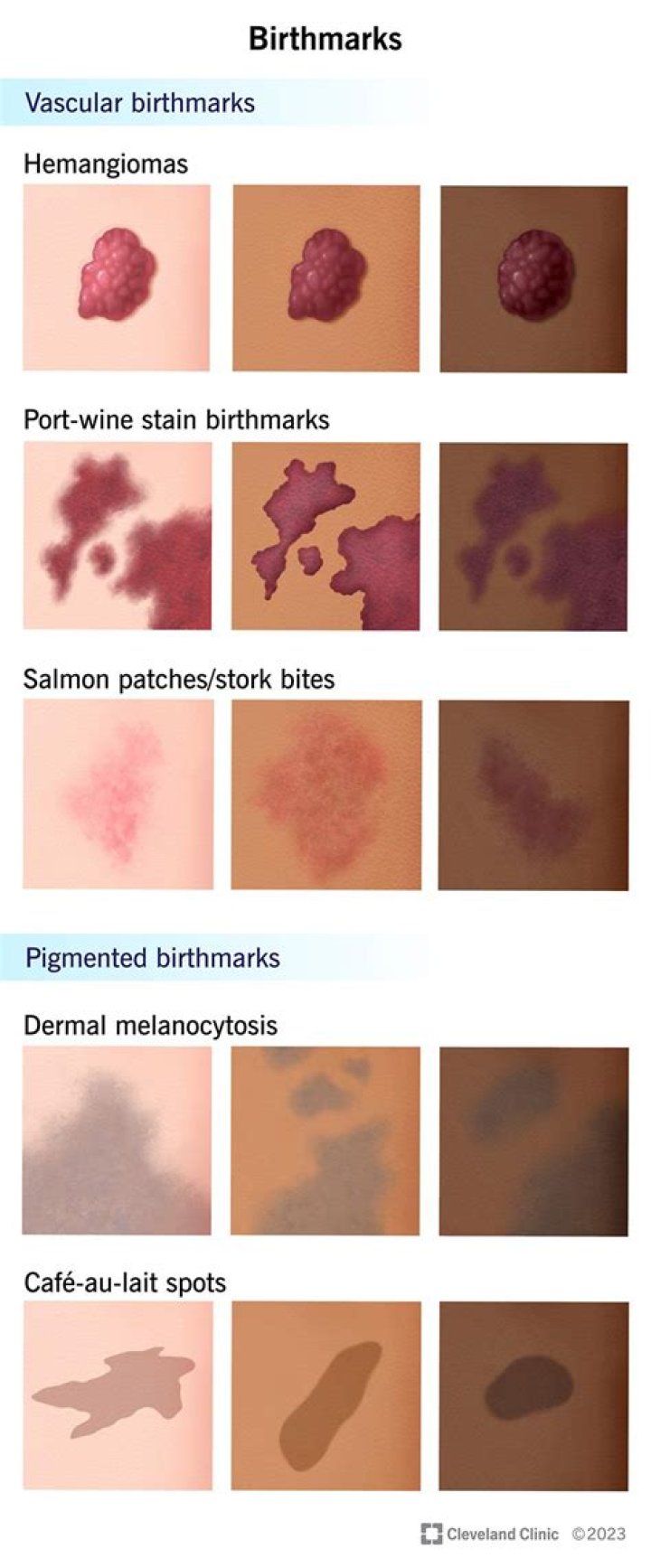 Can you tattoo over birthmark?