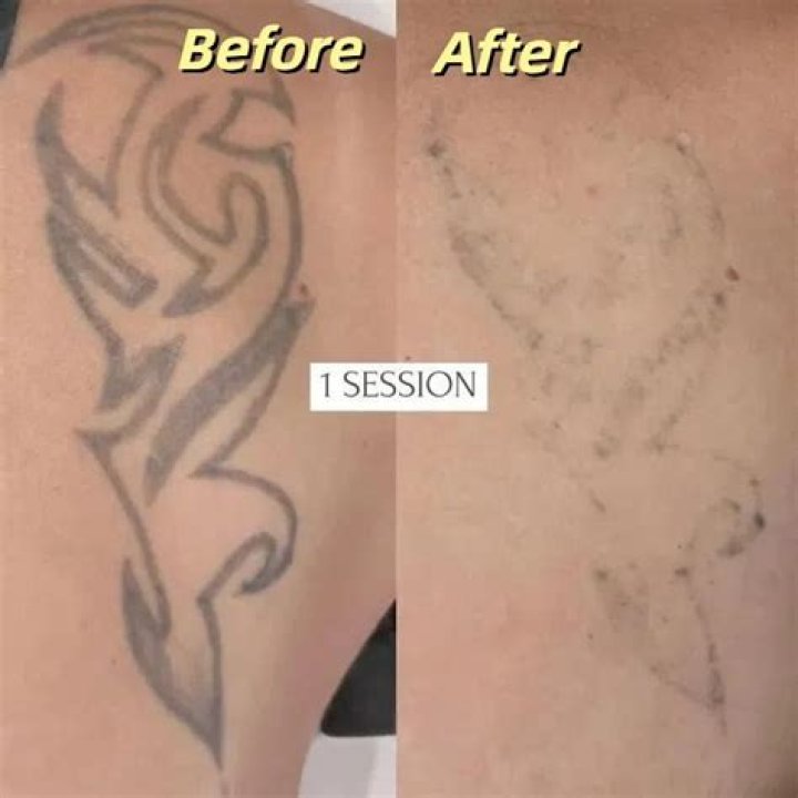 Can you tattoo over razor burn?