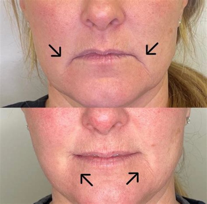 Can you use Botox to lift jowls?
