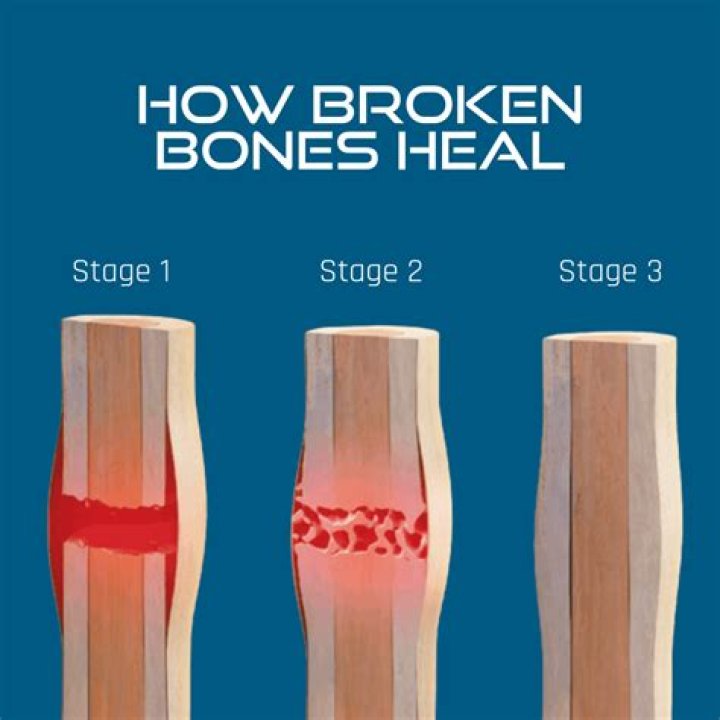 Do bones grow back after broken?
