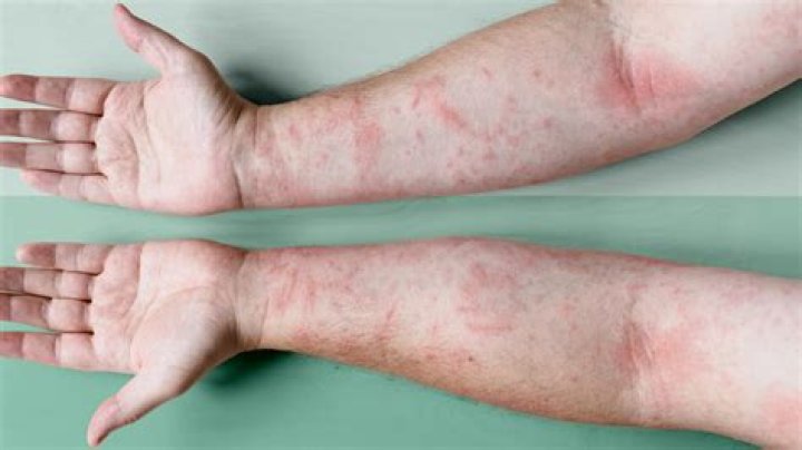 Do eggs trigger eczema?