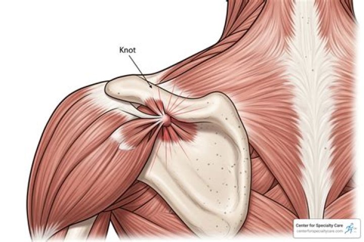 Do muscle knots feel like lumps?