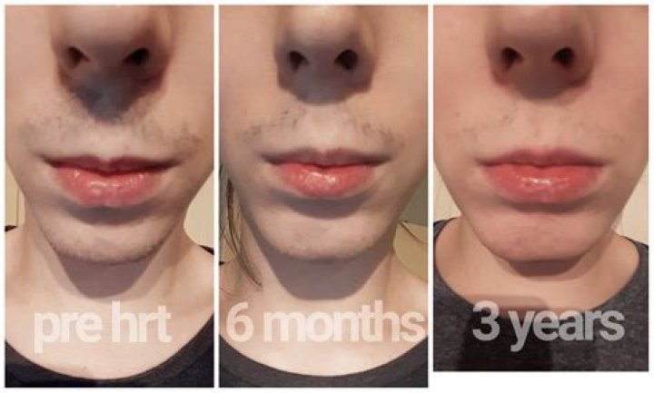 Does estrogen change your face?