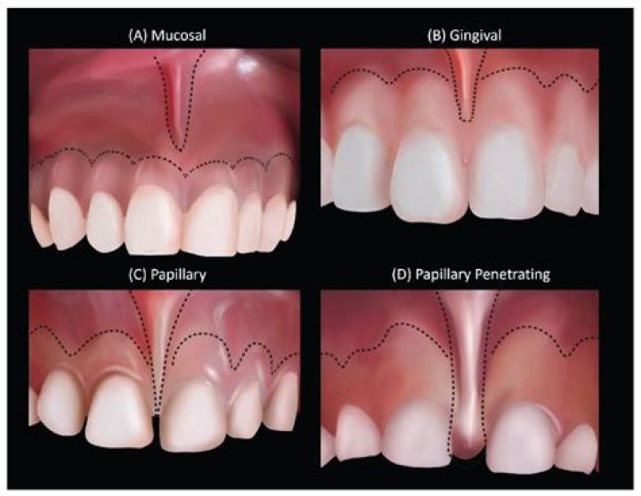 Does frenectomy affect smile?
