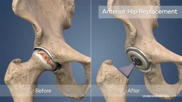 How do you care for someone after a hip replacement?
