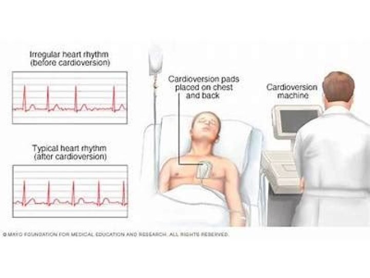 How long does a cardioversion take?