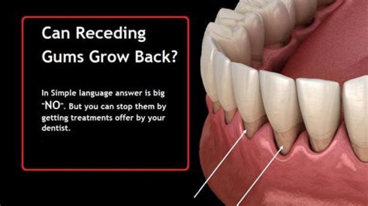 How long does it take for gum tissue to regenerate?