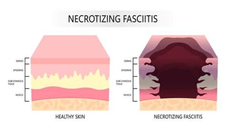 How long does necrosis take to heal?