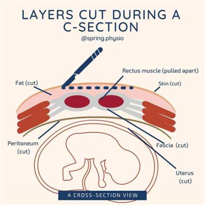 How many layers of skin is cut during C-section?