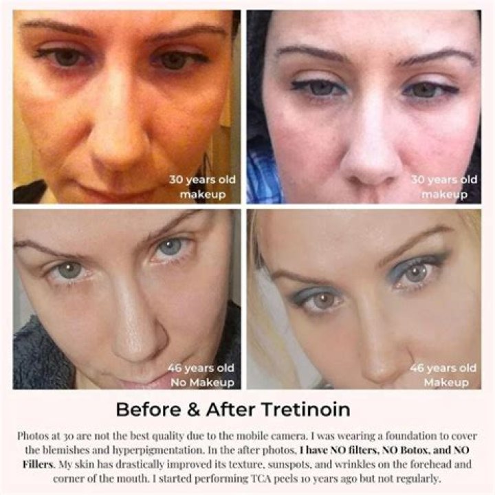 How often should I use Retin A for wrinkles?