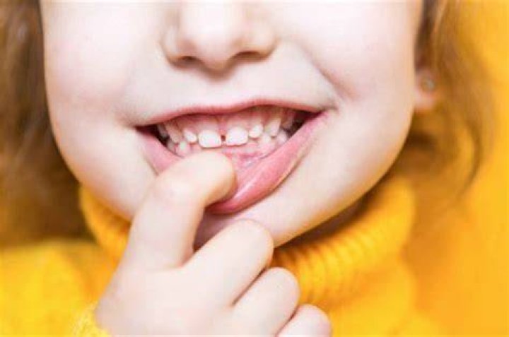 Is it okay to live with an overbite?