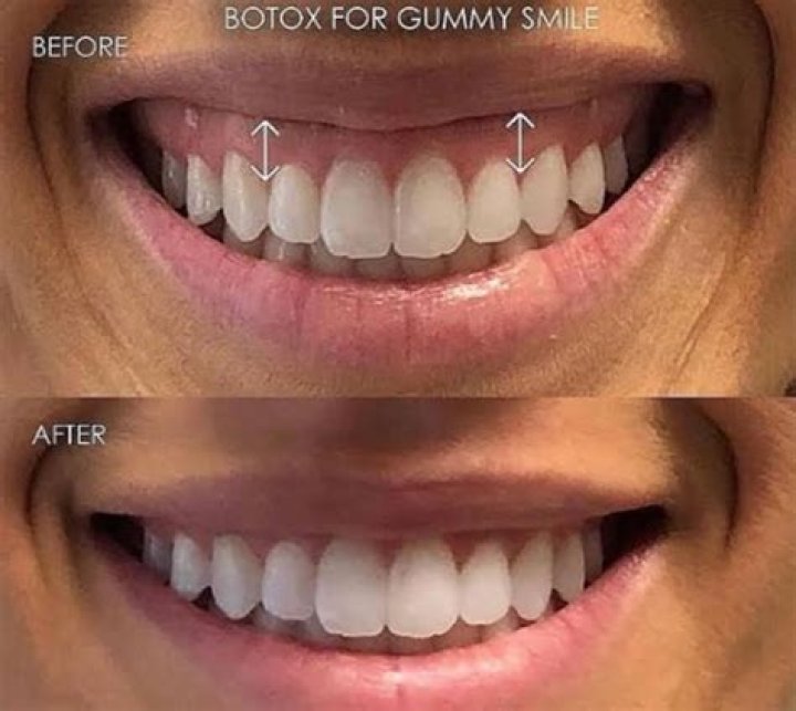 Is smile surgery allowed in Army?