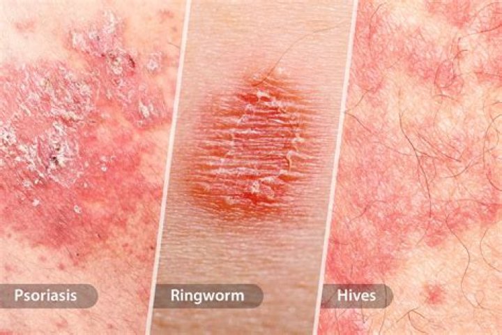 Is there a shot for eczema?