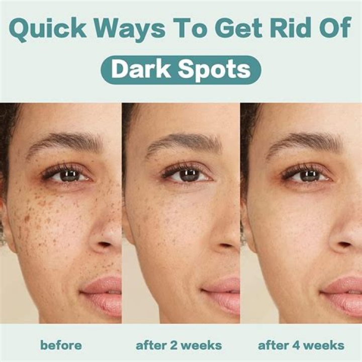 Is toothpaste good for dark spots?