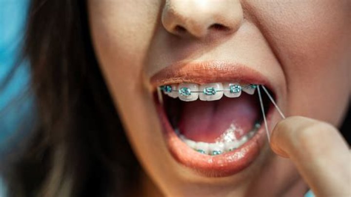 What's the longest for braces?