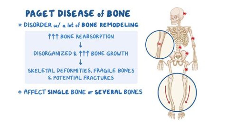 What are the three phases of Paget's disease?