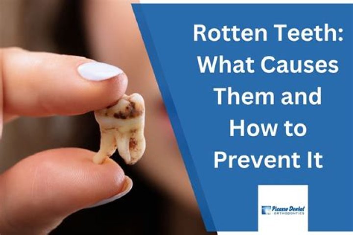 What can cause rotten teeth?