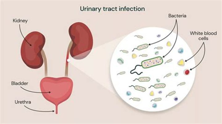 What can mimic kidney infection?