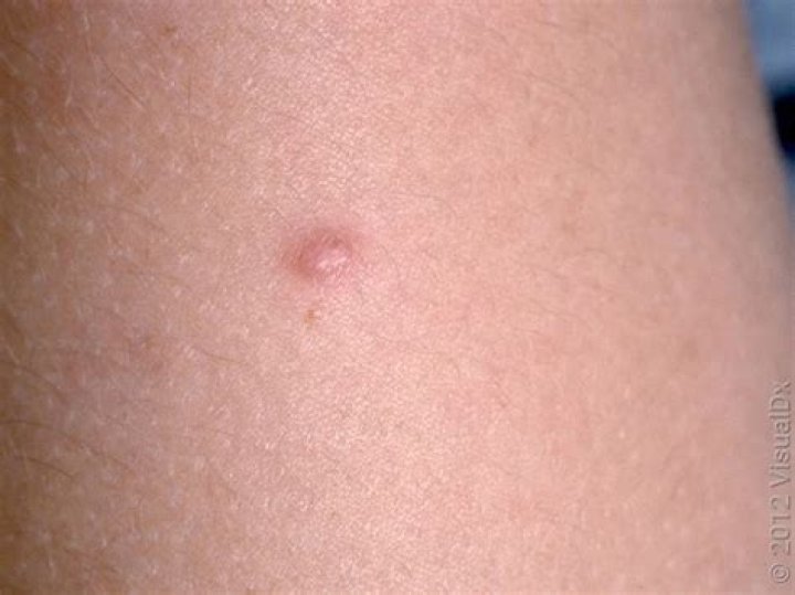 What causes multiple dermatofibroma?