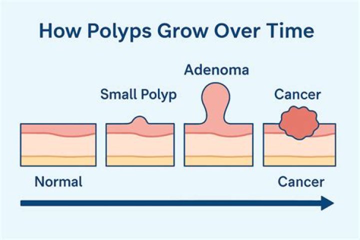 What happens if a removed polyp is cancerous?