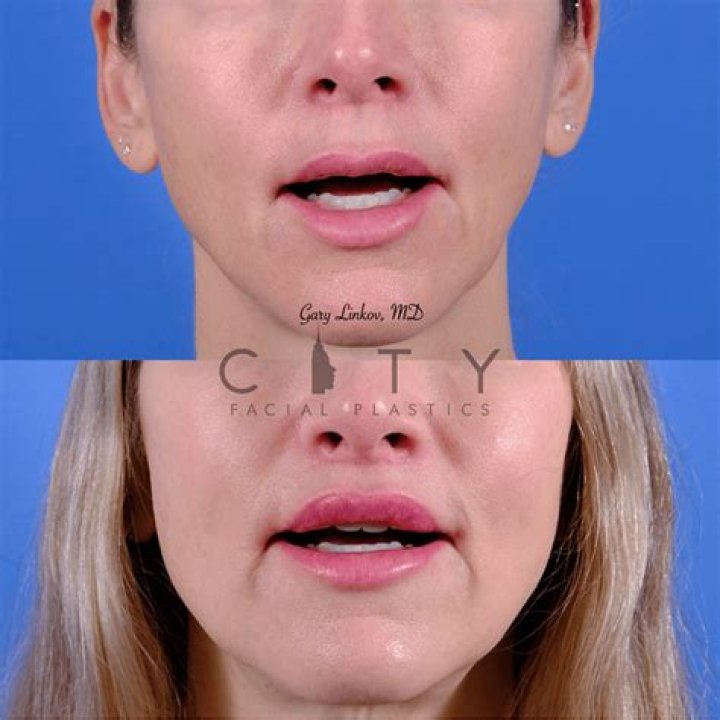 What is an Elelyft lip lift?
