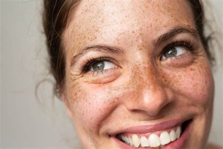 What is Hutchinson's freckle?