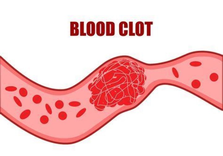 What is often mistaken for a blood clot?