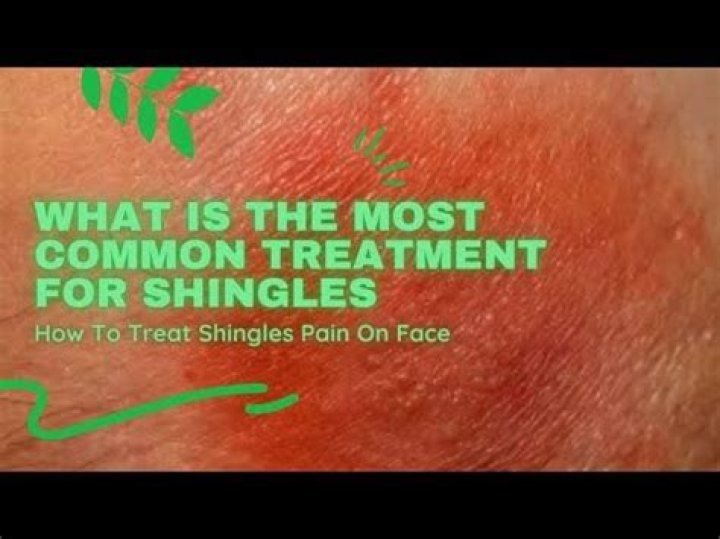 What is the most common treatment for shingles?