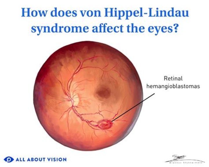 What is Von Hippel Lindau disease?