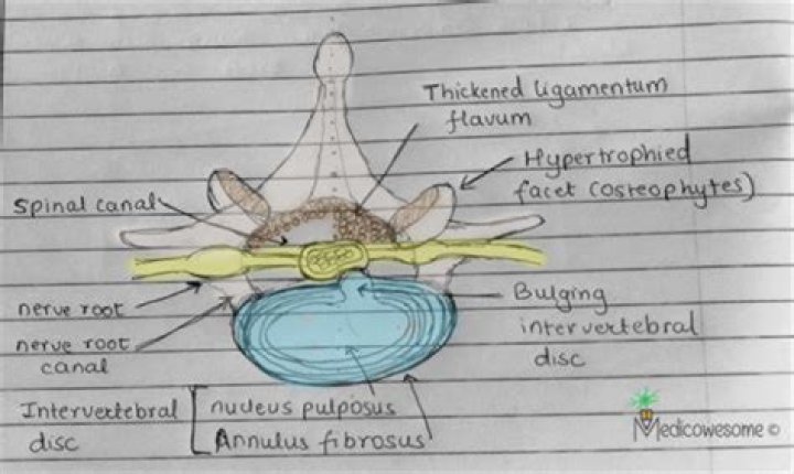 What nerves cause cauda equina?