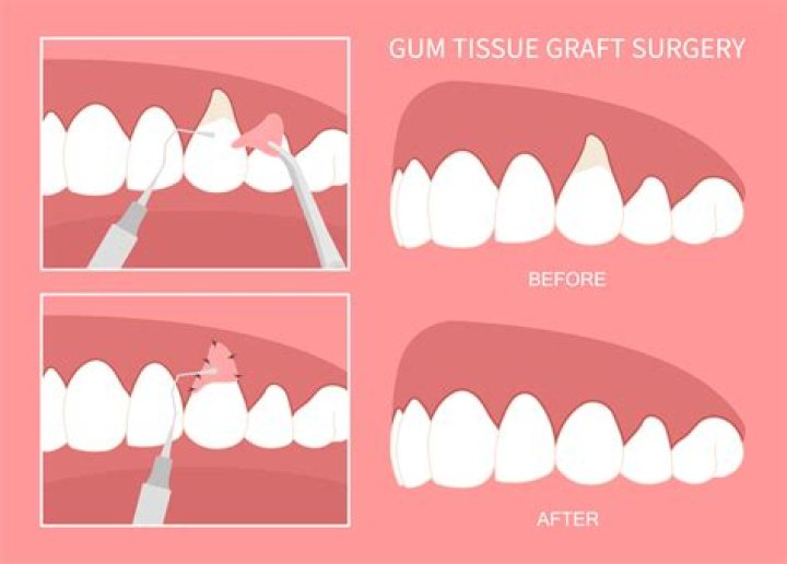 When can I exercise after gum graft?