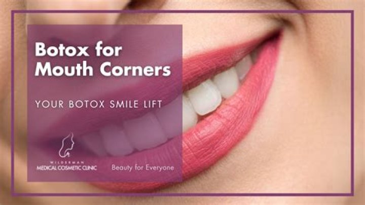 Where is Botox injected for smile lift?