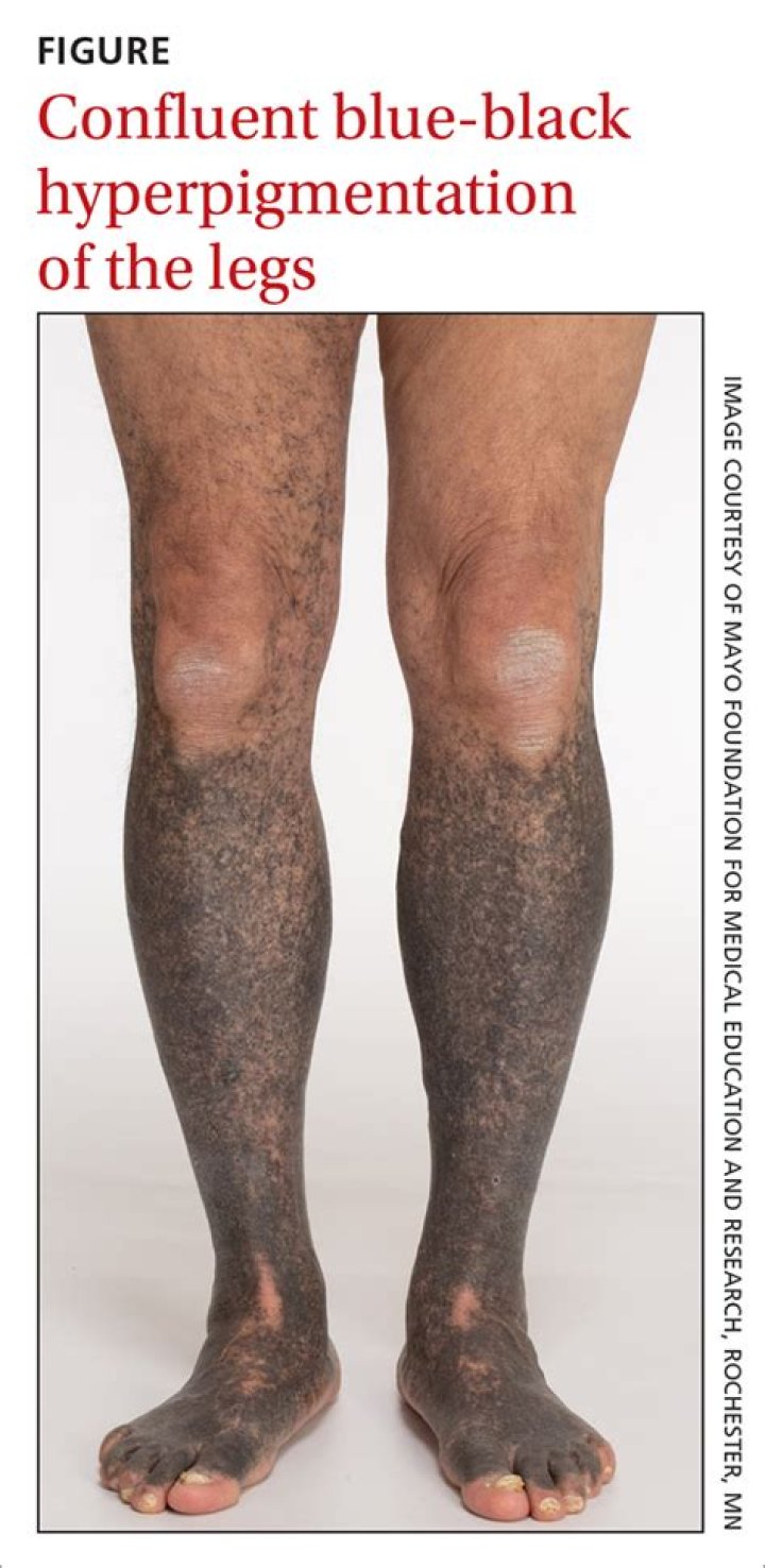Why is the hair on my legs turning black?